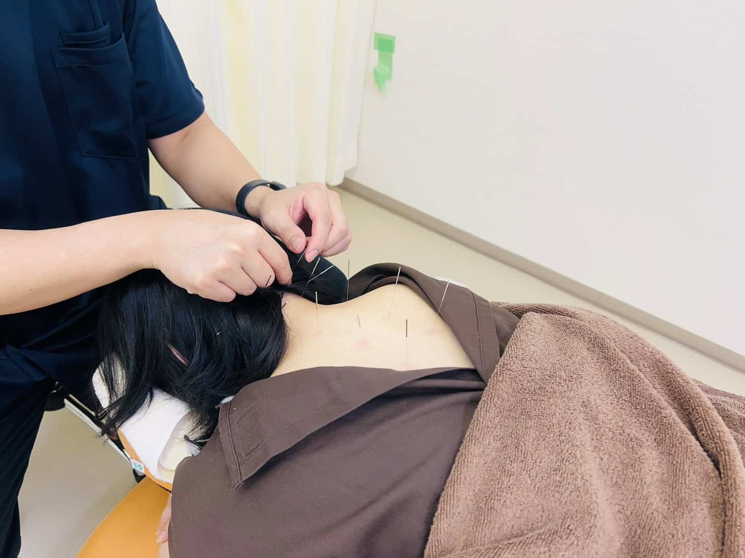 鍼灸施術の様子