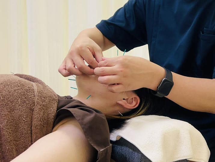 美顔鍼の施術