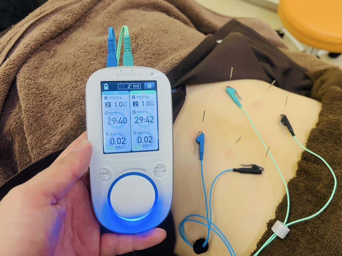 鍼通電療法での施術